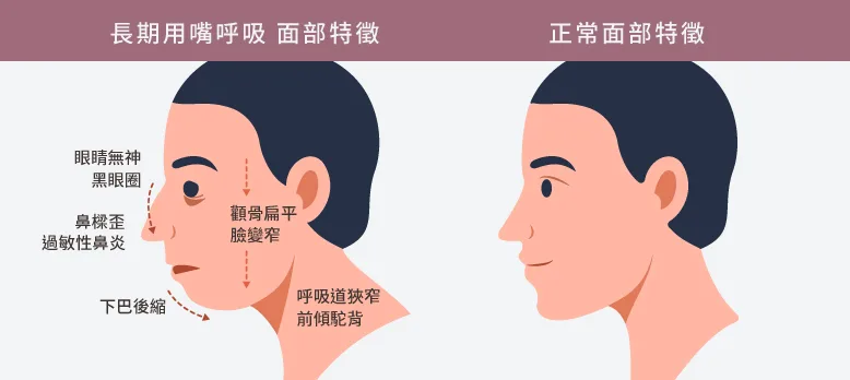 一名兒童張口呼吸的側臉示意插圖，用於說明長期口呼吸與顎面發育的衛教關聯